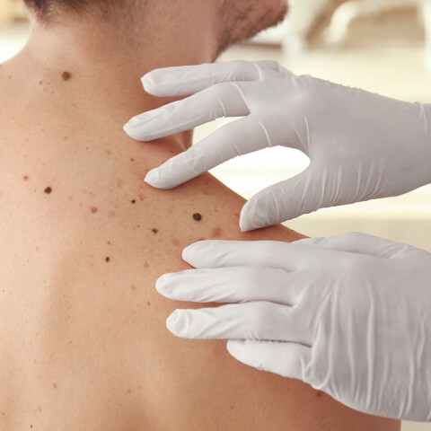 Mole Removal Male Tile